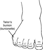 tailors bunion